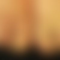 Lymphedema: 44-year-old female patient, Zn several erysipelas of the right lower leg with resulti...