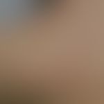 Anastrazol induzierte "unspezifische" Dermatitis (Abbildung bearbeitet und entommen aus&nbsp;Kim ...