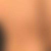 Pityriasis rosea: Mann, 36 Jahre. Seit ca. 10 Tagen deutlich juckendes Exanthem, Rumpf mit typisc...