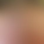 Alopezie vernarbende: Frau, 66 Jahre. Seit ca. 1 Jahr bemerkt die Patientin ein Zurückweichen des...