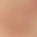 Flacher Herd mit deutlich pigmentiertem Randwall im Gesicht bei 80 jähriger Patientin. Im Bereich...