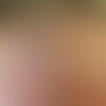 Frontal fibrosierende Alopezie&nbsp;: Frau, 66 Jahre. Seit ca. 1 Jahr bemerkt die Patientin ein Z...