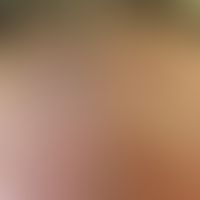 Frontal fibrosierende Alopezie&nbsp;: Frau, 66 Jahre. Seit ca. 1 Jahr bemerkt die Patientin ein Z...