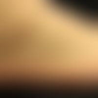 Mann, 41 Jahre. Seit Jahren bekannte Psoriasis mit relativ geringem Befall (Ellbögen, Knie, genit...