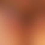 Erythrasma: Mann, 62 Jahre. Der Befund besteht seit Jahren und war nicht Anlass der Arztvorstellu...