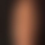 Pankreatitis-Pannikulitis-Polyarthritis-Syndrom: ältere, aphlegmasische Fettwebssatrophien.
