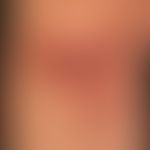 Pankreatitis-Pannikulitis-Polyarthritis-Syndrom:&nbsp;akute mäßig schmerzende Pannikulitis
