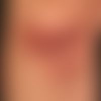 Pankreatitis-Pannikulitis-Polyarthritis-Syndrom:&nbsp;akute mäßig schmerzende Pannikulitis
