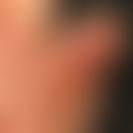Dyshidrotische Dermatitis: Mann, 41 Jahre. Seit Jahren Ekzemschübe an den Händen unklarer Genese ...