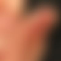 Dyshidrotische Dermatitis: Mann, 41 Jahre. Seit Jahren Ekzemschübe an den Händen unklarer Genese ...