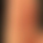 Dyshidrotische Dermatitis: Mann, 41 Jahre. Seit Jahren Ekzemschübe an den Händen unklarer Genese ...