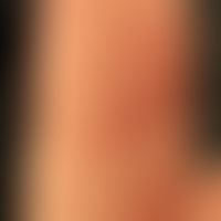 Dyshidrotische Dermatitis: Mann, 41 Jahre. Seit Jahren Ekzemschübe an den Händen unklarer Genese ...