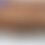 Eosinophile Pannikulitis: rötliche Knoten an beiden Unterschenkeln im Rahmen einer COVID-19-Infek...