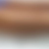 Eosinophile Pannikulitis: rötliche Knoten an beiden Unterschenkeln im Rahmen einer COVID-19-Infek...