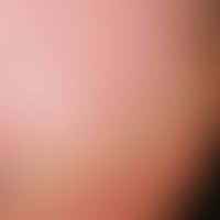 Onychorrhexis:&nbsp;horizontale Aufsplitterung der Nagelmatrix. Keine Grunderkrankung bekannt.&nb...