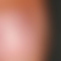 Onychorrhexis:&nbsp;horizontale Aufsplitterung der Nagelmatrix. Keine Grunderkrankung bekannt.&nb...