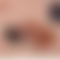 Melanom superfiziell spreitendes: langsam progredientes Melanom mit Regressionszonen. Seit&nbsp;e...
