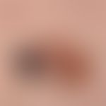 Melanom superfiziell spreitendes: langsam progredientes Melanom mit Regressionszonen. Seit&nbsp;e...