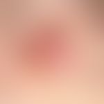 Melanom, amelanotisches: Seit >2 Jahren betstehnder schmerzloser Knoten.&nbsp;Dieser habe in&n...