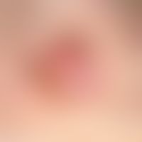 Melanom, amelanotisches: Seit >2 Jahren betstehnder schmerzloser Knoten.&nbsp;Dieser habe in&n...