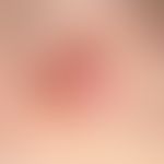 Differenzialdiagnose Merkel-Zell-Karzinom: ulzeriertes amelanotisches Melanom. Lokalisation an de...