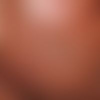 Superfizielle Follikulitis: Mulitple kleine follikulär gebundene Pusteln (Nachweis von Staph. aur...