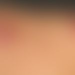Differenzialdiagnose "Dermatofibrosarcoma protuberans"

Diagnose: Massive Keloidbildung bei Akne ...