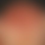 Aktinische Keratosen:&nbsp;zahlreiche, hyperkeratotische rote Papeln und Plaques am Kapillitium e...