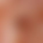 Elastose mit Komedonenbildung: Auflichtmikroskopie ohne Kontaktmedium (Jochbogenregion): Braune H...