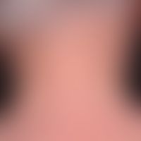 Elastose: Schwere aktinisch induzierte Elastose der Nackenregion mit grobem Faltenrelief.&nbsp;
