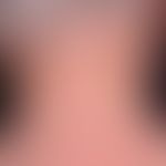 Elastose: Schwere aktinisch induzierte Elastose der Nackenregion mit grobem Faltenrelief.&nbsp;
