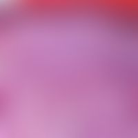 Elastose: Schollige elastotische Veränderung der oberen und mittleren Anteile des Koriums (HE-Fär...