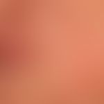 Chronische Cheilitis bei Lupus erythematodes chronicus discoides: chronisch aktive, rote, hyperäs...