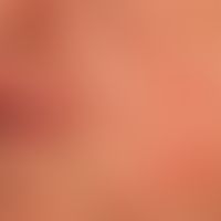 Chronische Cheilitis bei Lupus erythematodes chronicus discoides: chronisch aktive, rote, hyperäs...