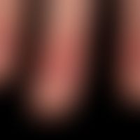 Chilblain-Lupus:&nbsp;flächige, mäßig&nbsp;schmerzhafte, leicht keratotische&nbsp;Plaques an den ...