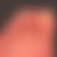 Chilblain Lupus: &nbsp;temperaturabhängige livide Verfärbung aller Zehen mit umschriebenen schmer...