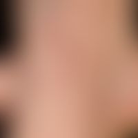 Lichen planus (klassischer Typ):&nbsp;chronisch aktive, multiple, zunehmende, disseminiert stehen...
