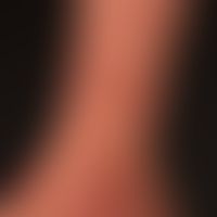 Artefakte: punkt- und strichförmige Erosionen&nbsp;und Krustenbildungen. Am Handrücken großflächi...