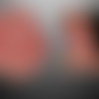 Basalzellkarzinom sklerodermiformes: s. Abb. voraus. Morphologische Besonderheiten die zur klinis...