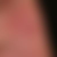 Basalzellkarzinom sklerodermiformes: unscheinbare, wenig scharf begrenzte, völlig symptomlose,&nb...