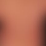 Zytomegalievirus - makulo-papulöses Exanthem): Exanthem bei schwerer,&nbsp;grippeartiger&nbsp;Sym...