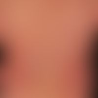 Zytomegalievirus - makulo-papulöses Exanthem): Exanthem bei schwerer,&nbsp;grippeartiger&nbsp;Sym...