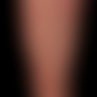 Zytomegalievirus - makulo-papulöses Exanthem): Exanthem bei schwerer,&nbsp;grippeartiger&nbsp;Sym...