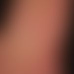 Zytomegalievirus - makulo-papulöses Exanthem): Exanthem bei schwerer,&nbsp;grippeartiger&nbsp;Sym...