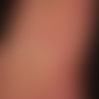 Zytomegalievirus - makulo-papulöses Exanthem): Exanthem bei schwerer,&nbsp;grippeartiger&nbsp;Sym...