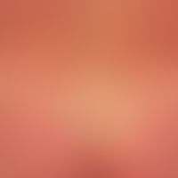 Zytomegalievirus - makulo-papulöses Exanthem): Exanthem bei schwerer,&nbsp;grippeartiger&nbsp;Sym...