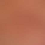 Differenzialdiagnose "Dermatofibrosarcoma protuberans"

Diagnose: überraschend weicher, nicht wac...