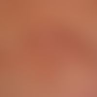 Differenzialdiagnose "Dermatofibrosarcoma protuberans"

Diagnose: überraschend weicher, nicht wac...