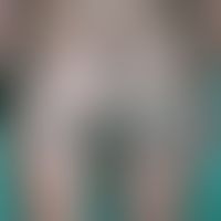 Differenzialdiagnoe Vitiligo: Lepra lepromatosa B (Boderline Typ) mit großflächigen deutlich infi...