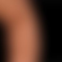Differenzialdiagnose Vitiligo:&nbsp;Eschenlaubflecken bei M. Bourneville Pringle
